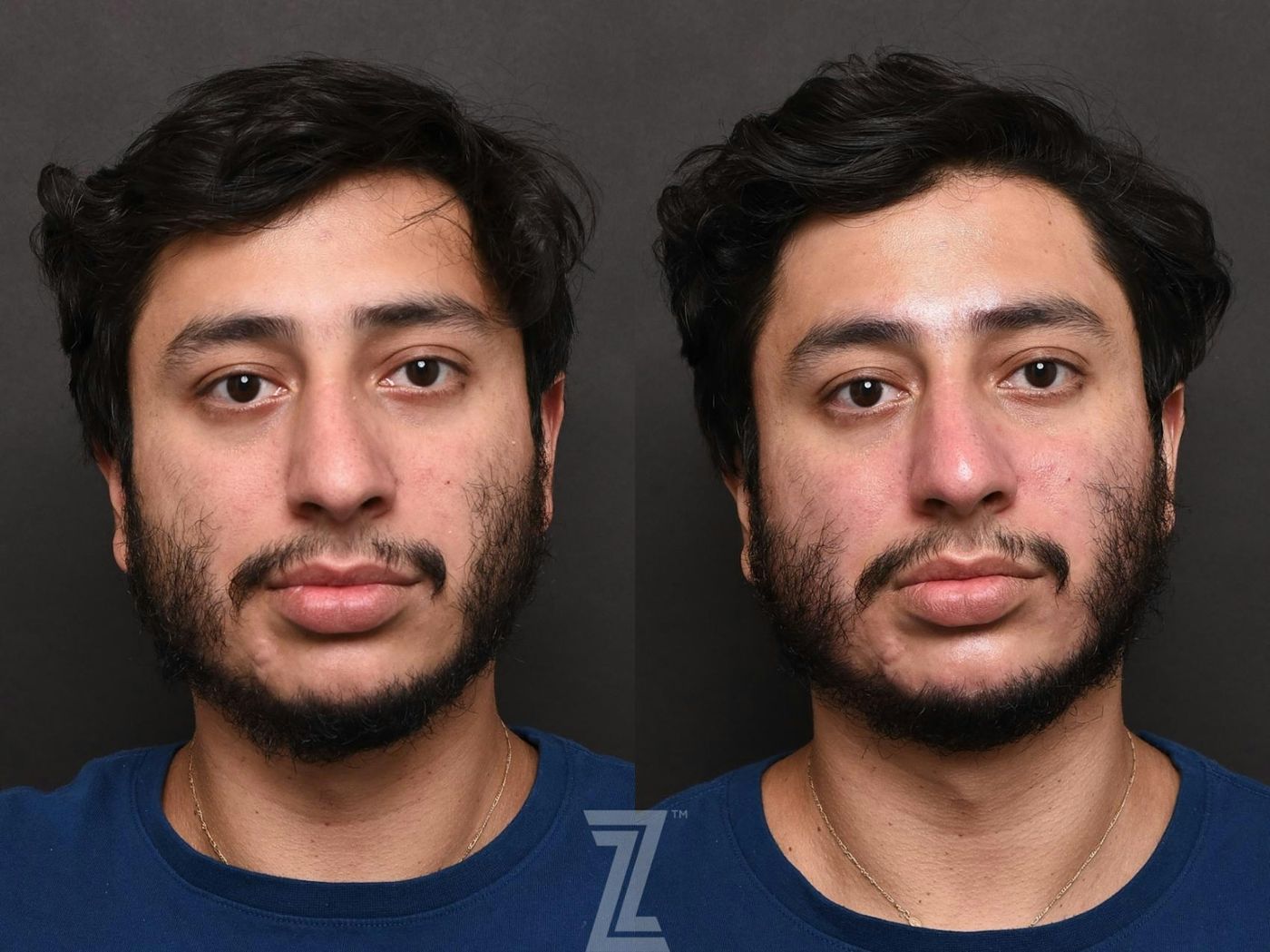 Austin HydraFacial™ Before & After Gallery - Patient 132963244 - Image 1 - The Piazza Center