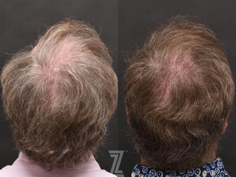 Austin Hair Restoration Before & After Gallery - Patient 132963587 - Image 1 - The Piazza Center