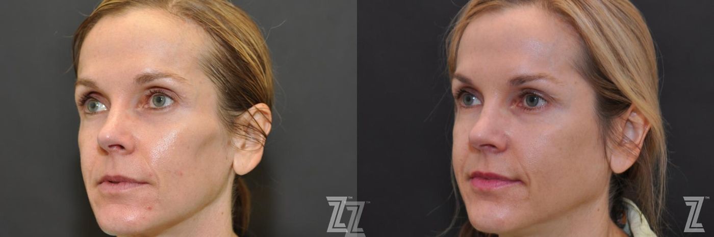 Austin Sculptra® Before & After Gallery - Patient 132963136 - Image 2 - The Piazza Center
