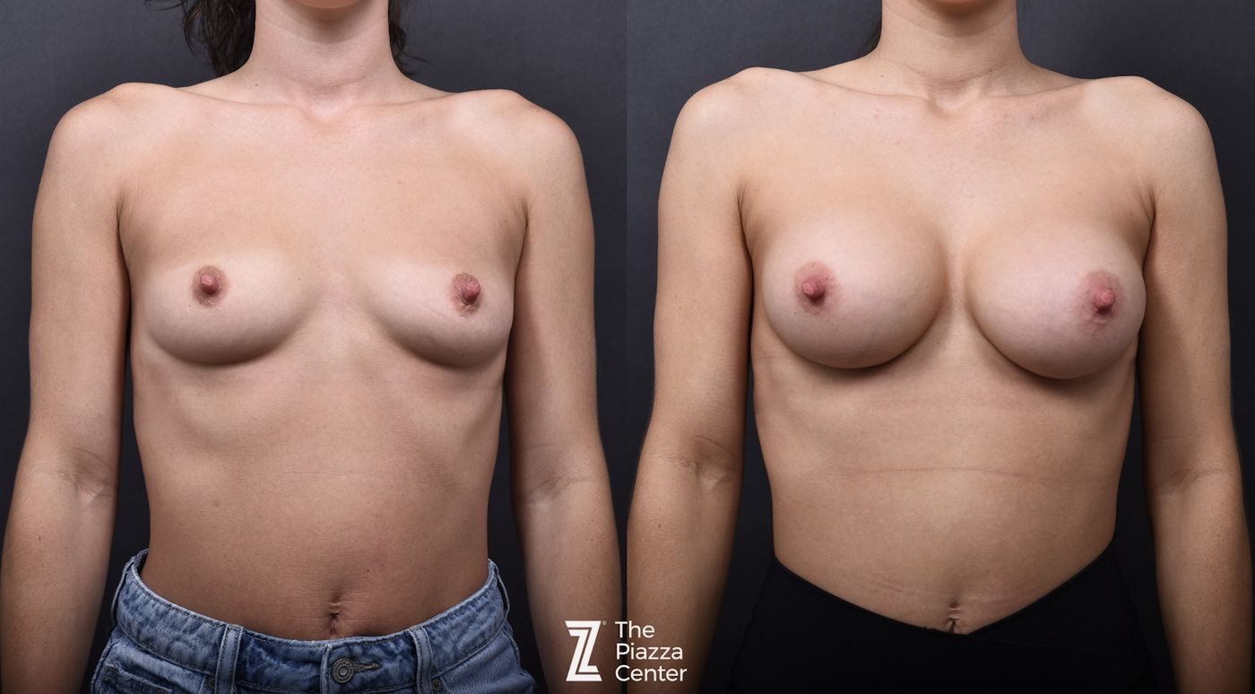 Austin Breast Augmentation - The Piazza Center