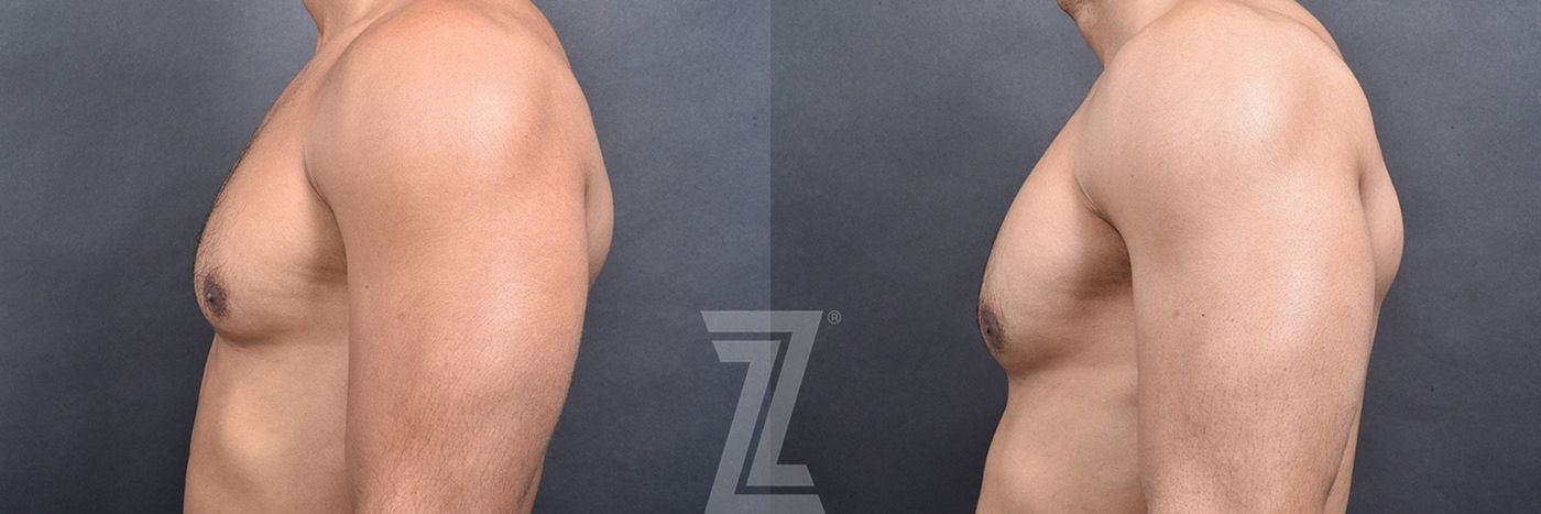 Austin Male Breast Reduction Before & After Gallery - Patient 104454 - Image 4 - The Piazza Center