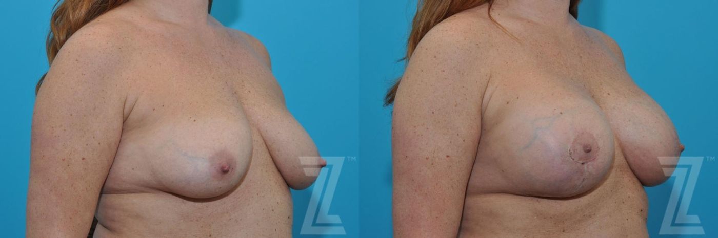 Austin Breast Augmentation With a Breast Lift Before & After Gallery - Patient 132791088 - Image 4 - The Piazza Center