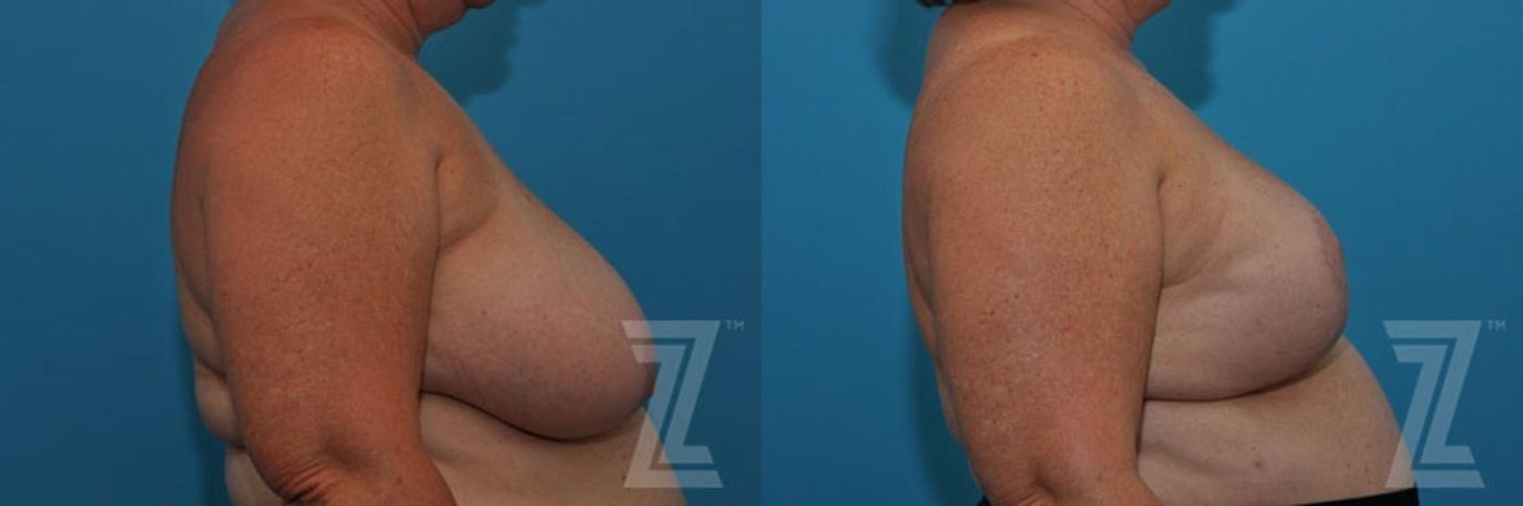 Austin Breast Reduction Before & After Gallery - Patient 132886617 - Image 5 - The Piazza Center