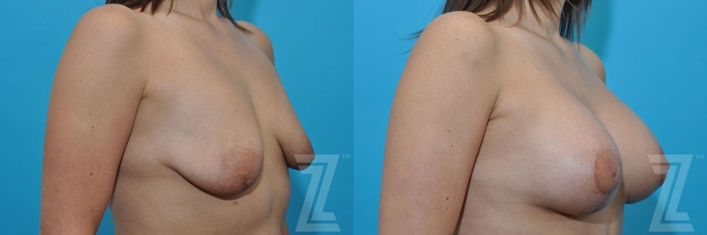 Austin Breast Augmentation With a Breast Lift Before & After Gallery - Patient 132791109 - Image 5 - The Piazza Center