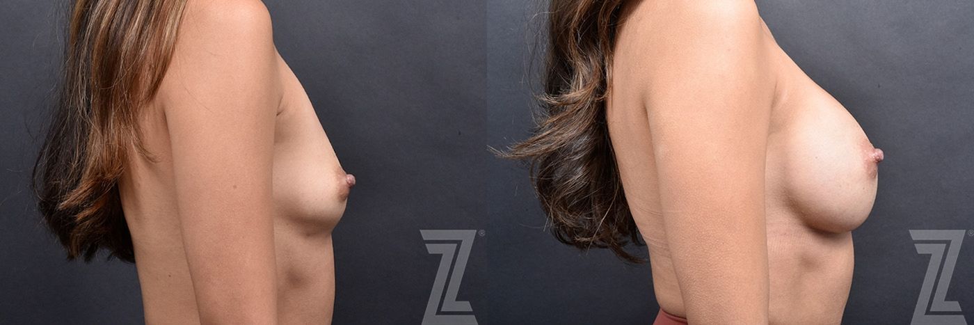 Austin Side View 1 Year Transformation Before & After Breast Augmentation at The Piazza Center in Austin - Dr. Rocco Piazza - The Piazza Center