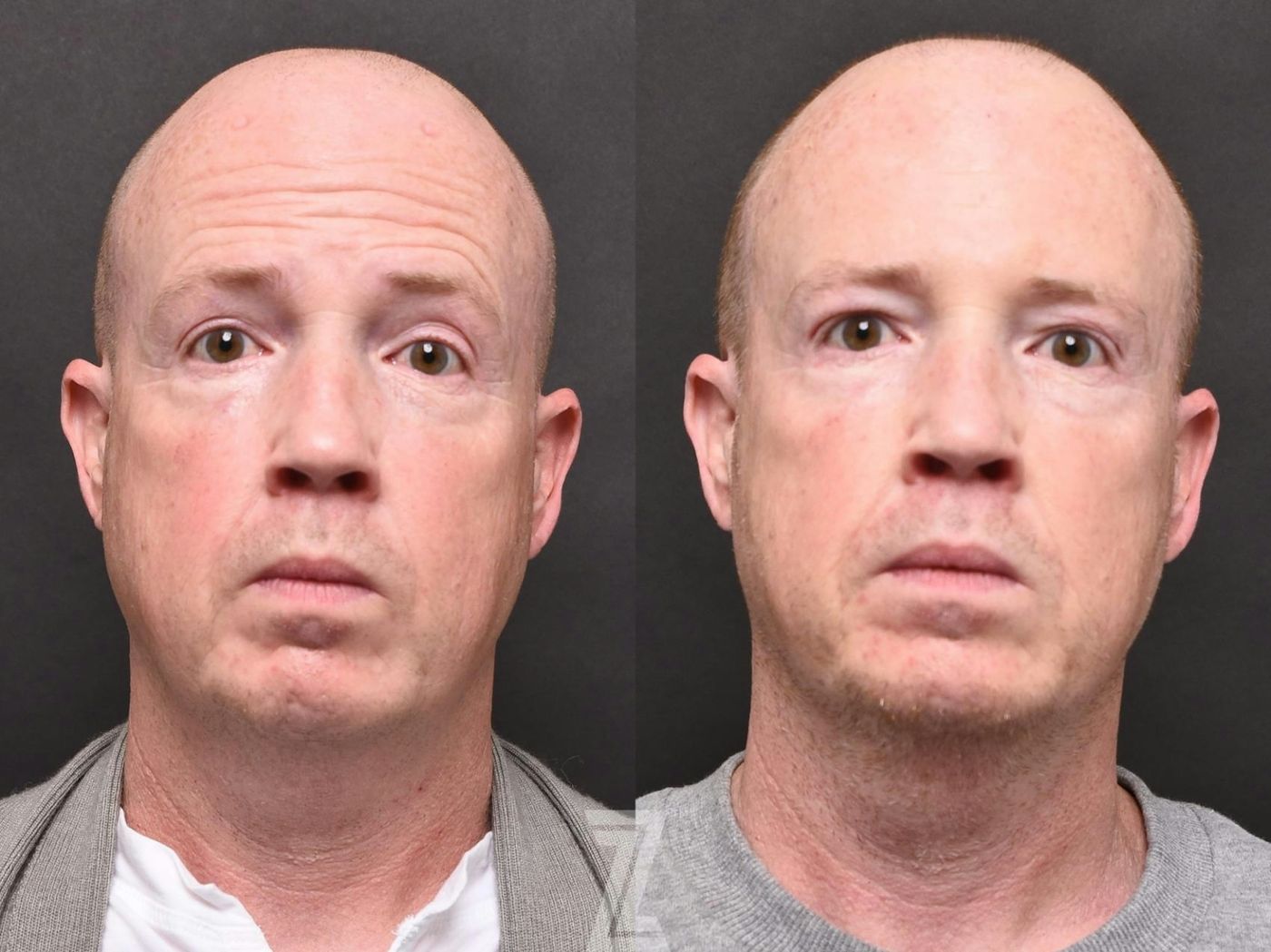 Austin Wrinkle Relaxers Before & After Gallery - Patient 132906313 - Image 1 - The Piazza Center