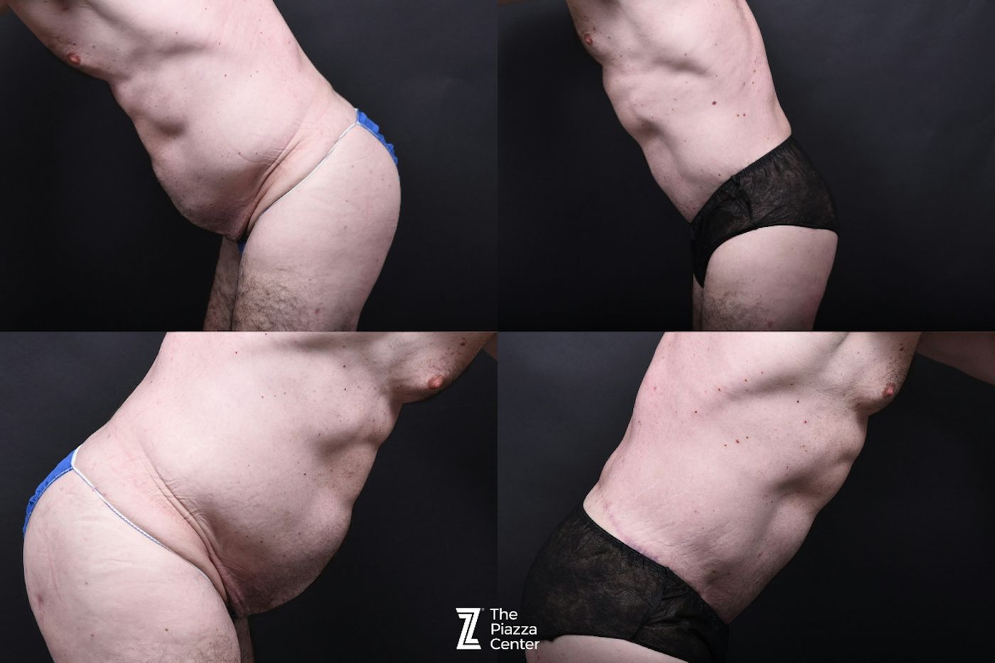 Austin Tummy Tuck Before & After Gallery - Patient 220707 - Image 4 - The Piazza Center