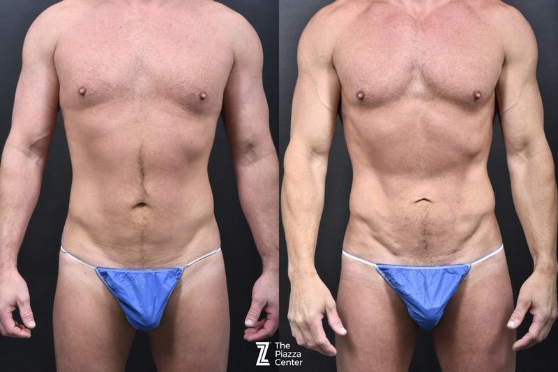 Austin Male Body Contouring Before & After Gallery - Patient 219361 - Image 1 - The Piazza Center