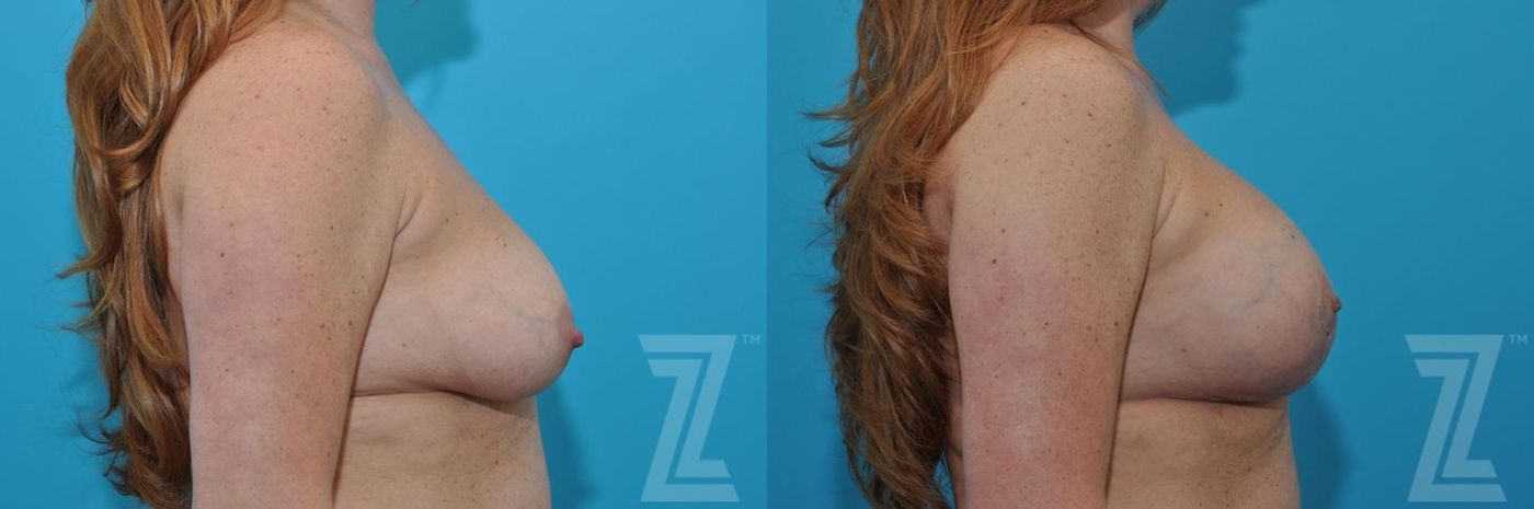 Austin Breast Augmentation With a Breast Lift Before & After Gallery - Patient 132791088 - Image 5 - The Piazza Center