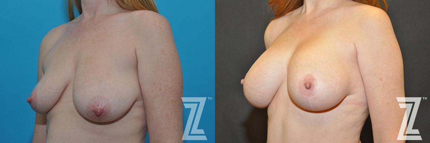 Austin Correction of Breast Asymmetry Before & After Gallery - Patient 132886778 - Image 2 - The Piazza Center