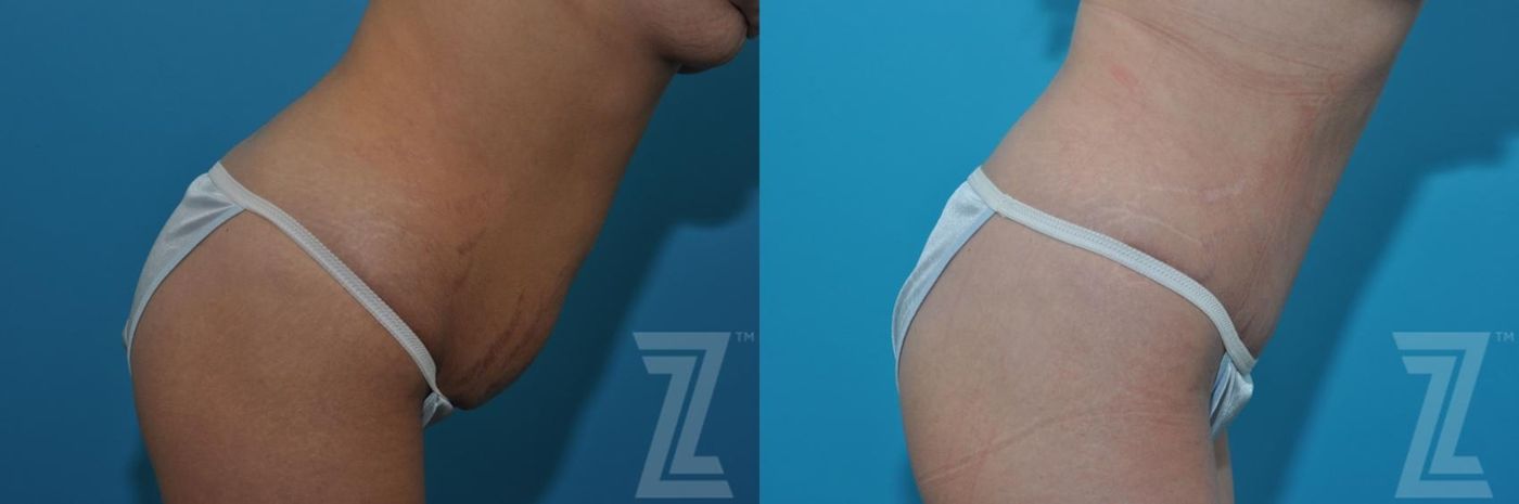 Austin Tummy Tuck Before & After Gallery - Patient 132886879 - Image 5 - The Piazza Center