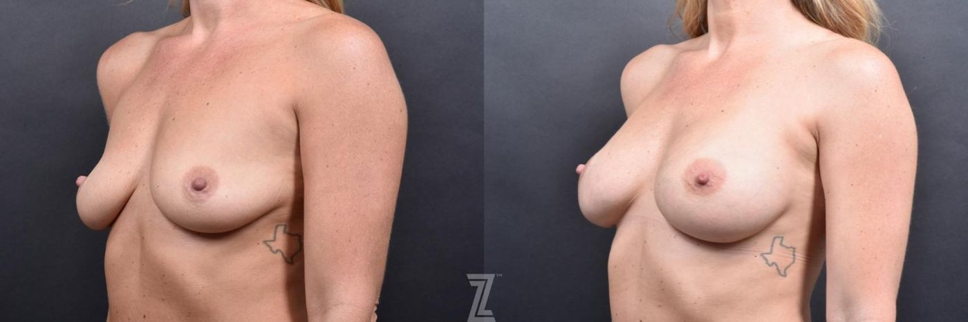 Austin Oblique view Before & After of 36 Year old woman breast augmentation - Piazza Center - The Piazza Center