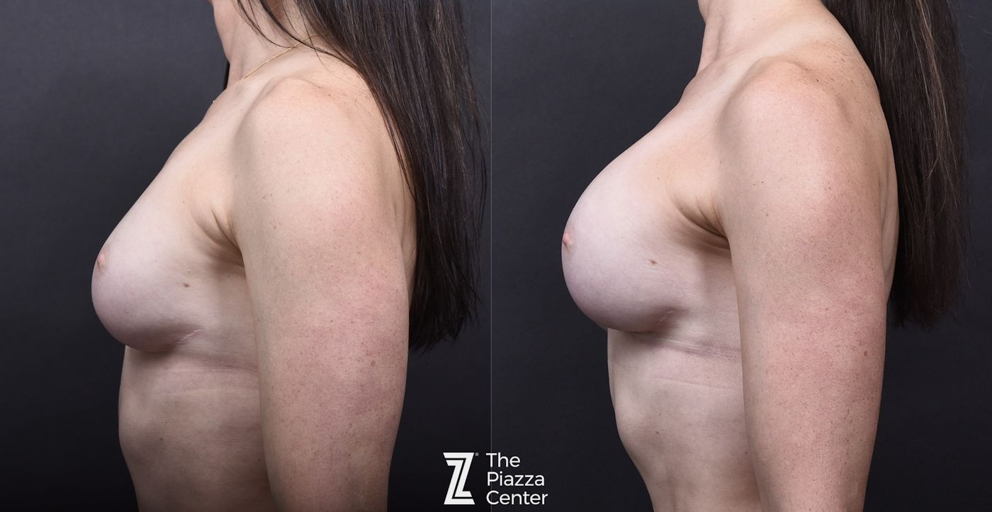 Austin Motiva Implants Before & After Gallery - Patient 257093 - Image 3 - The Piazza Center