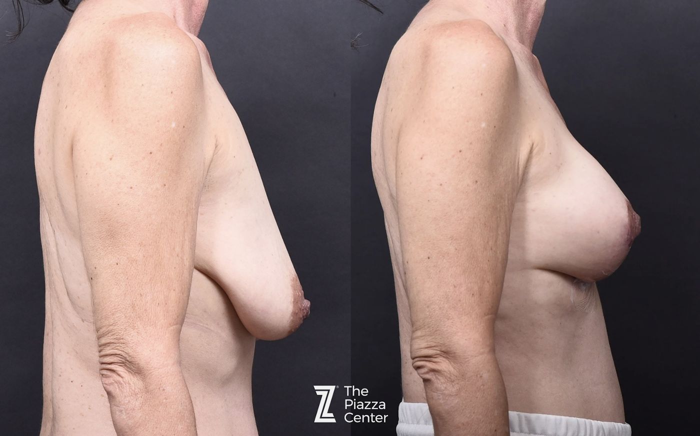 Austin Breast Augmentation With a Breast Lift - The Piazza Center