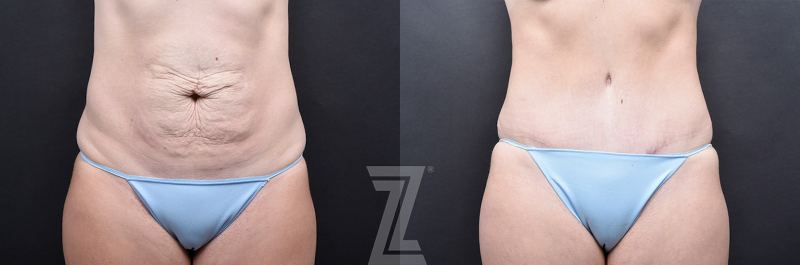 Austin Tummy Tuck Before & After Gallery - Patient 139211 - Image 1 - The Piazza Center