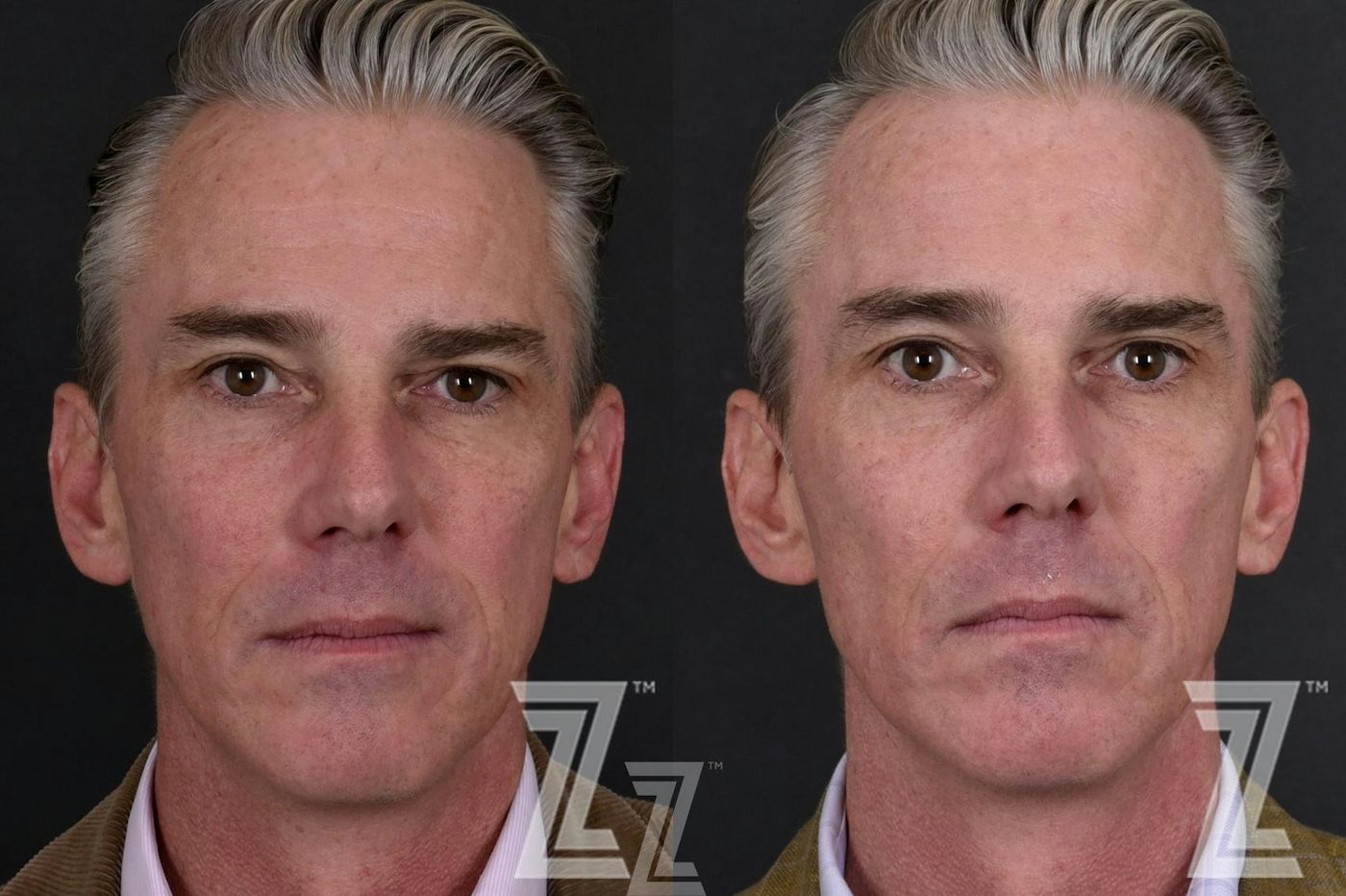 Austin Male Skin Treatments Before & After Gallery - Patient 336028 - Image 1 - The Piazza Center