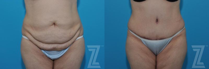 Austin Tummy Tuck Before & After Gallery - Patient 132886862 - Image 1 - The Piazza Center