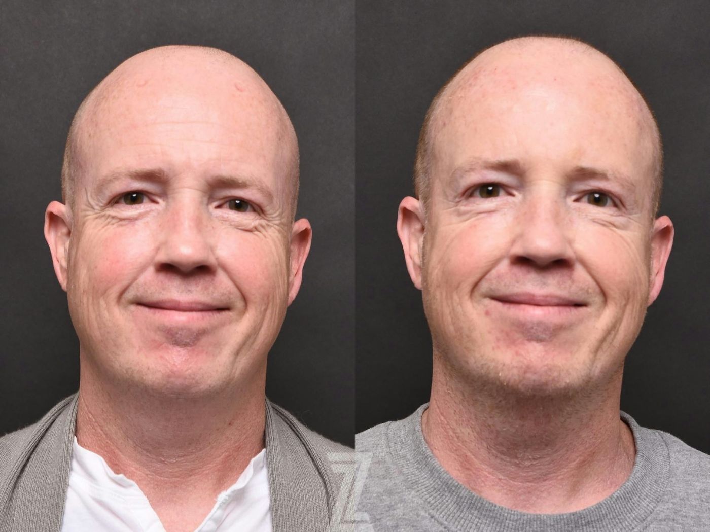 Austin Wrinkle Relaxers Before & After Gallery - Patient 132906313 - Image 3 - The Piazza Center