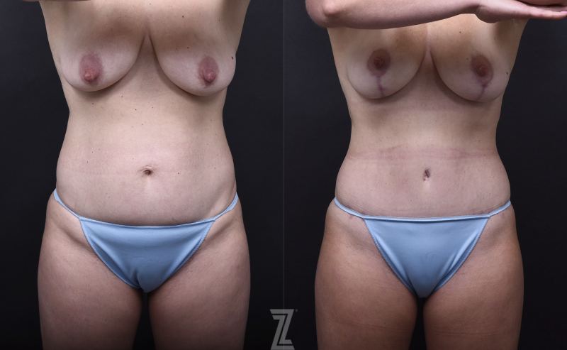 Austin Tummy Tuck Before & After Gallery - Patient 169865 - Image 1 - The Piazza Center