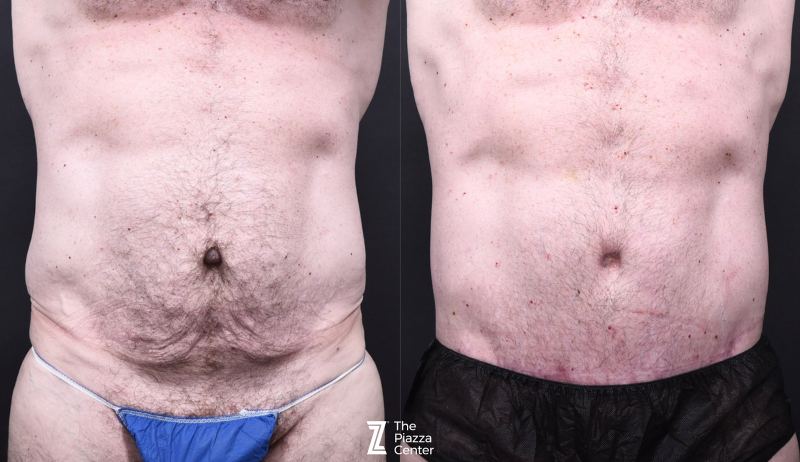 Austin Tummy Tuck Before & After Gallery - Patient 220707 - Image 1 - The Piazza Center
