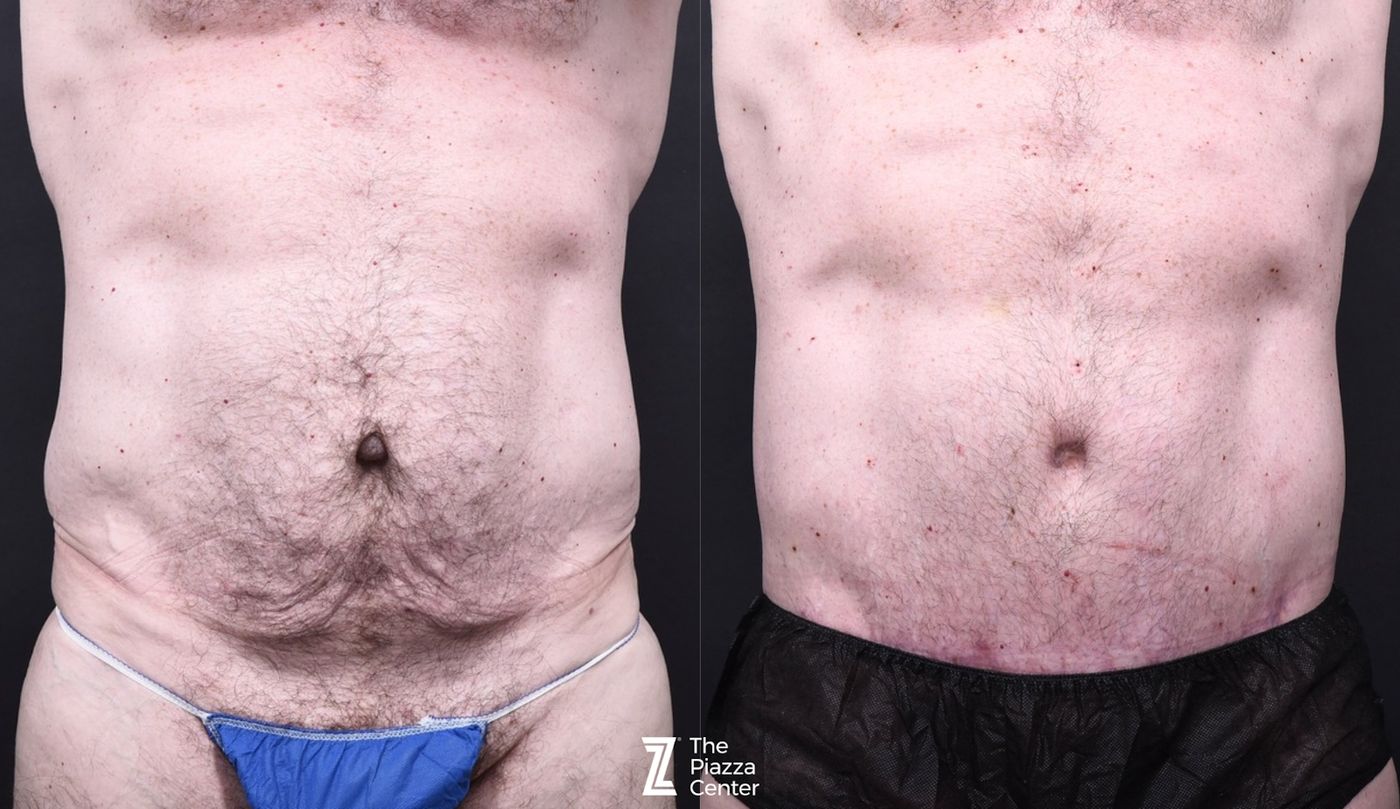 Austin Tummy Tuck Before & After Gallery - Patient 220707 - Image 1 - The Piazza Center