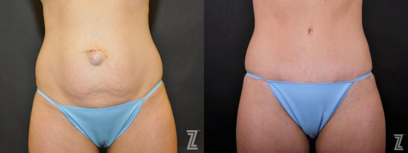 Austin Tummy Tuck Before & After Gallery - Patient 132886895 - Image 1 - The Piazza Center