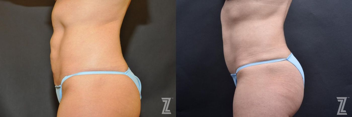 Austin Skin Pinch Before & After Gallery - Patient 132886938 - Image 2 - The Piazza Center