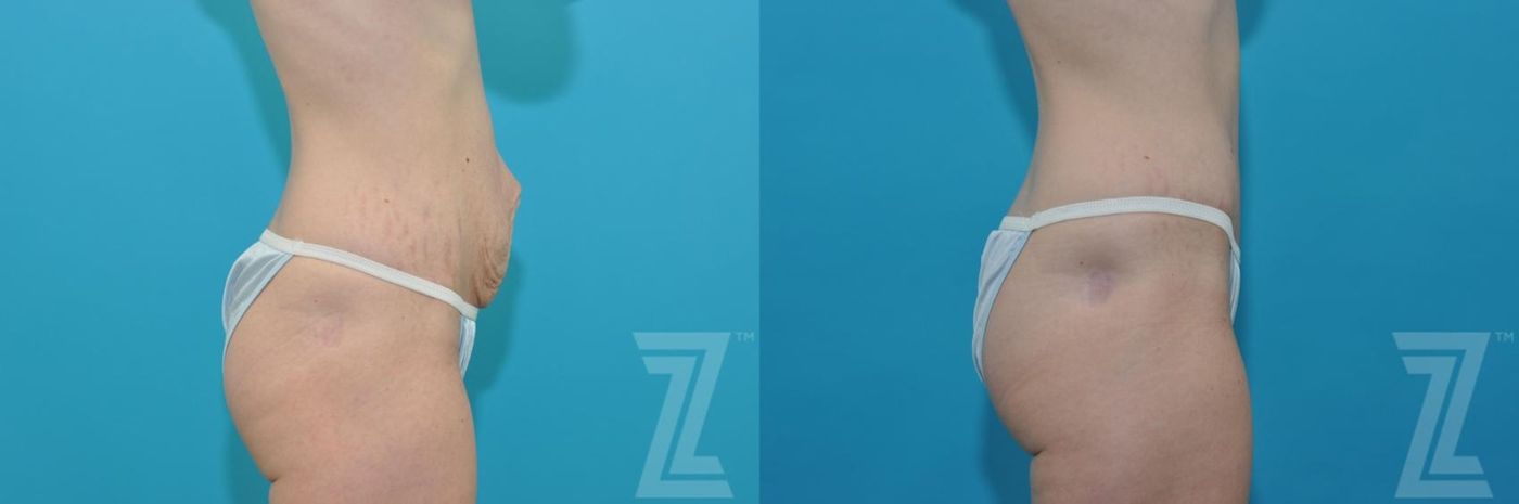 Austin Tummy Tuck Before & After Gallery - Patient 132886867 - Image 4 - The Piazza Center