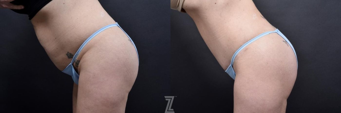 Austin Tummy Tuck Before & After Gallery - Patient 132886820 - Image 3 - The Piazza Center