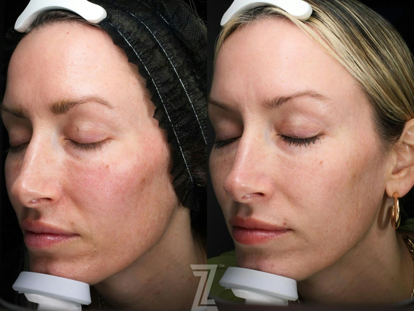 Austin SkinPen Microneedling Before & After Gallery - Patient 115122 - Image 1 - The Piazza Center