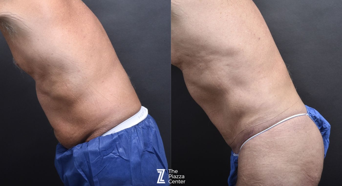 Austin Skin Pinch Before & After Gallery - Patient 283397 - Image 3 - The Piazza Center