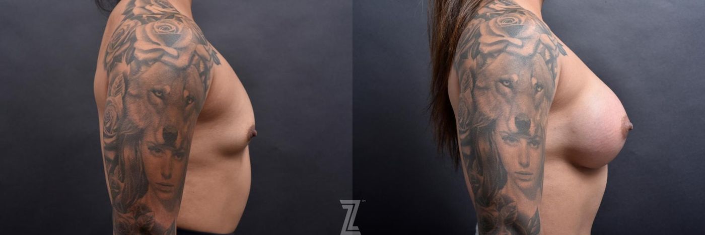 Austin Lateral view of before and after image 3 month post op 25 year old woman with Silicone Implants with Cohesive Silicone Gel - The Piazza Center