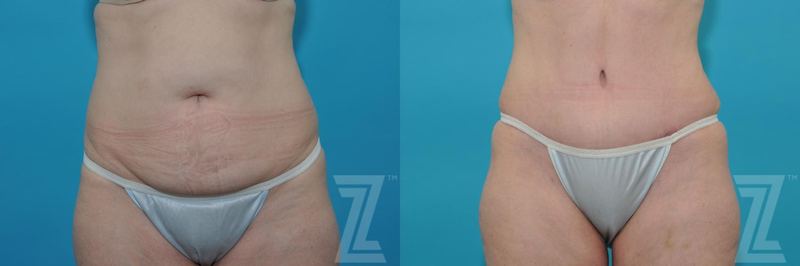 Austin Tummy Tuck Before & After Gallery - Patient 132886874 - Image 1 - The Piazza Center