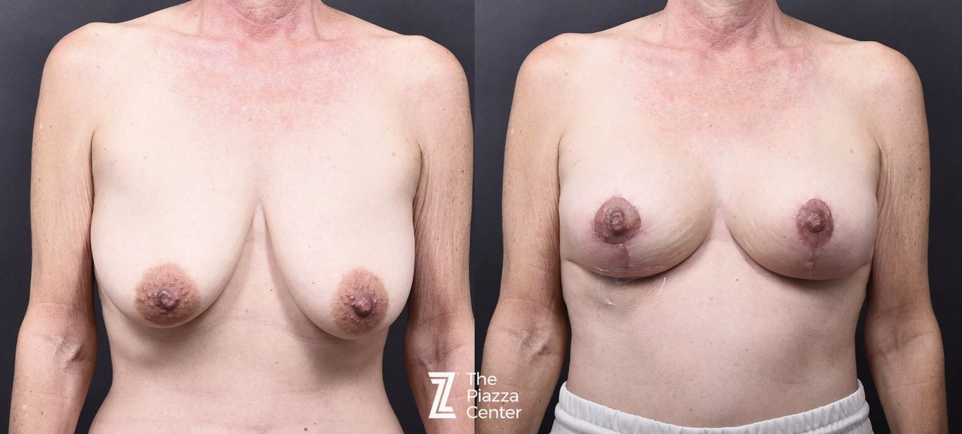 Austin Breast Augmentation With a Breast Lift - The Piazza Center