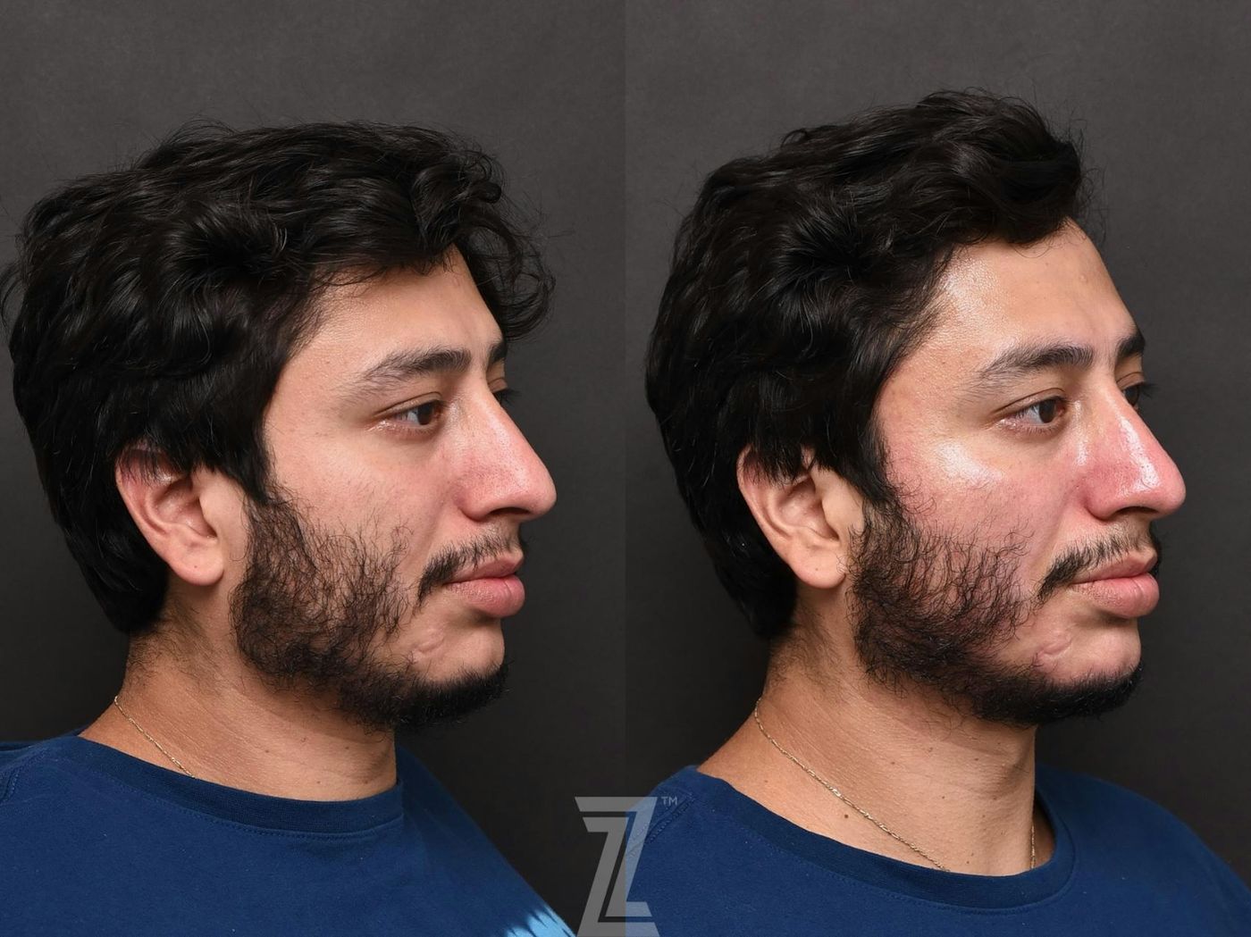 Austin HydraFacial™ Before & After Gallery - Patient 132963244 - Image 2 - The Piazza Center