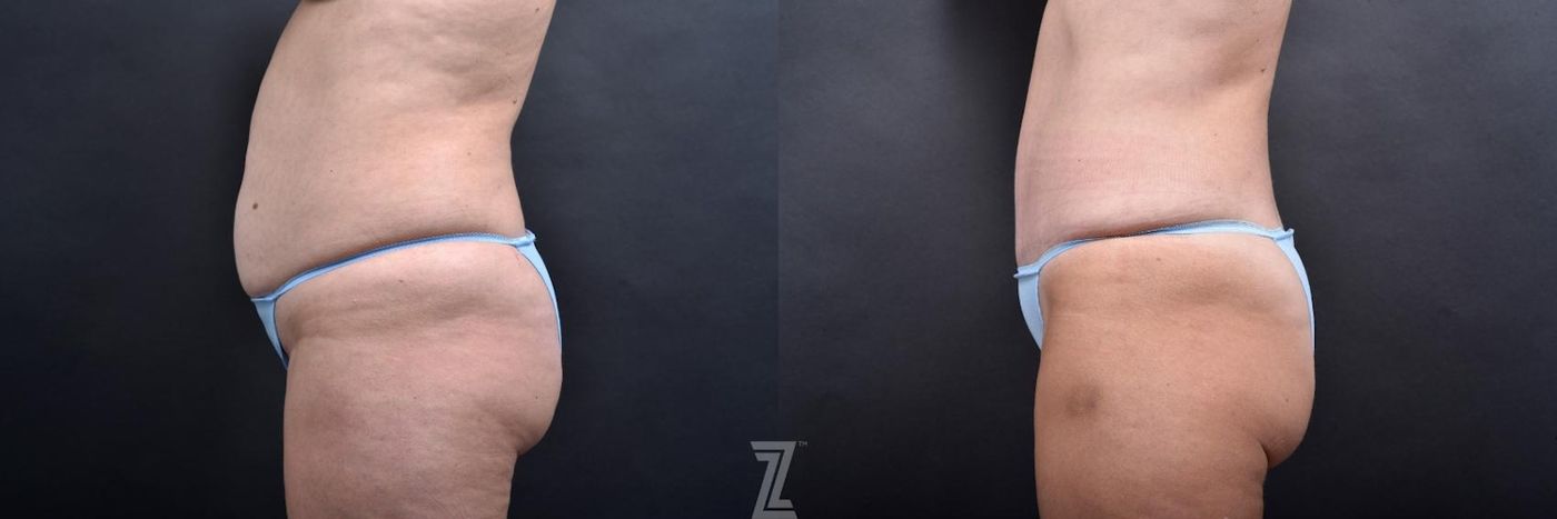 Austin Tummy Tuck Before & After Gallery - Patient 132886865 - Image 2 - The Piazza Center