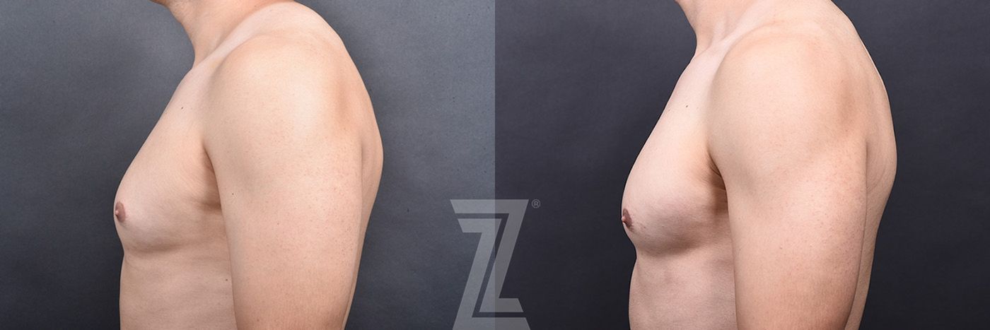 Austin Gynecomastia/Male Breast Reduction Before & After Gallery - Patient 105962 - Image 5 - The Piazza Center