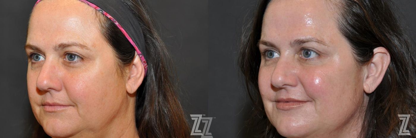 Austin Injectable Fillers Before & After Gallery - Patient 132906324 - Image 2 - The Piazza Center