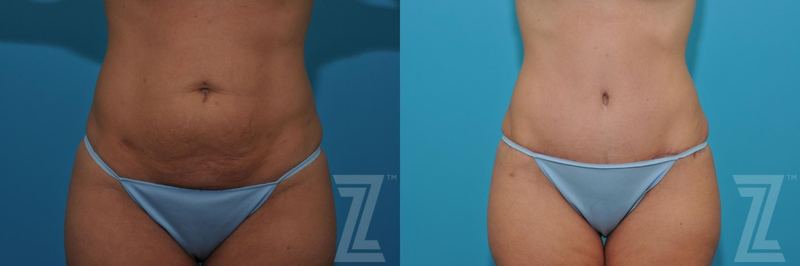 Austin Tummy Tuck Before & After Gallery - Patient 132886876 - Image 1 - The Piazza Center