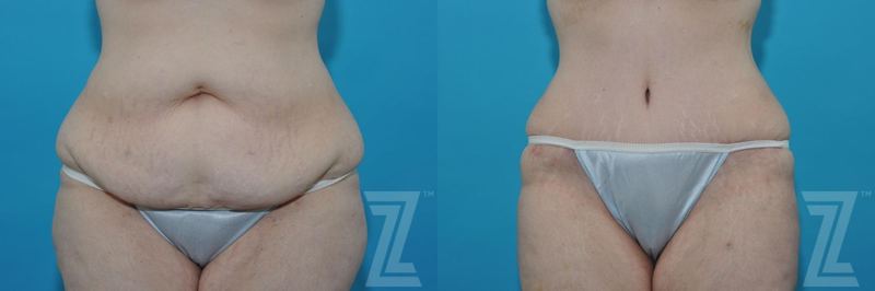 Austin Tummy Tuck Before & After Gallery - Patient 132886824 - Image 1 - The Piazza Center