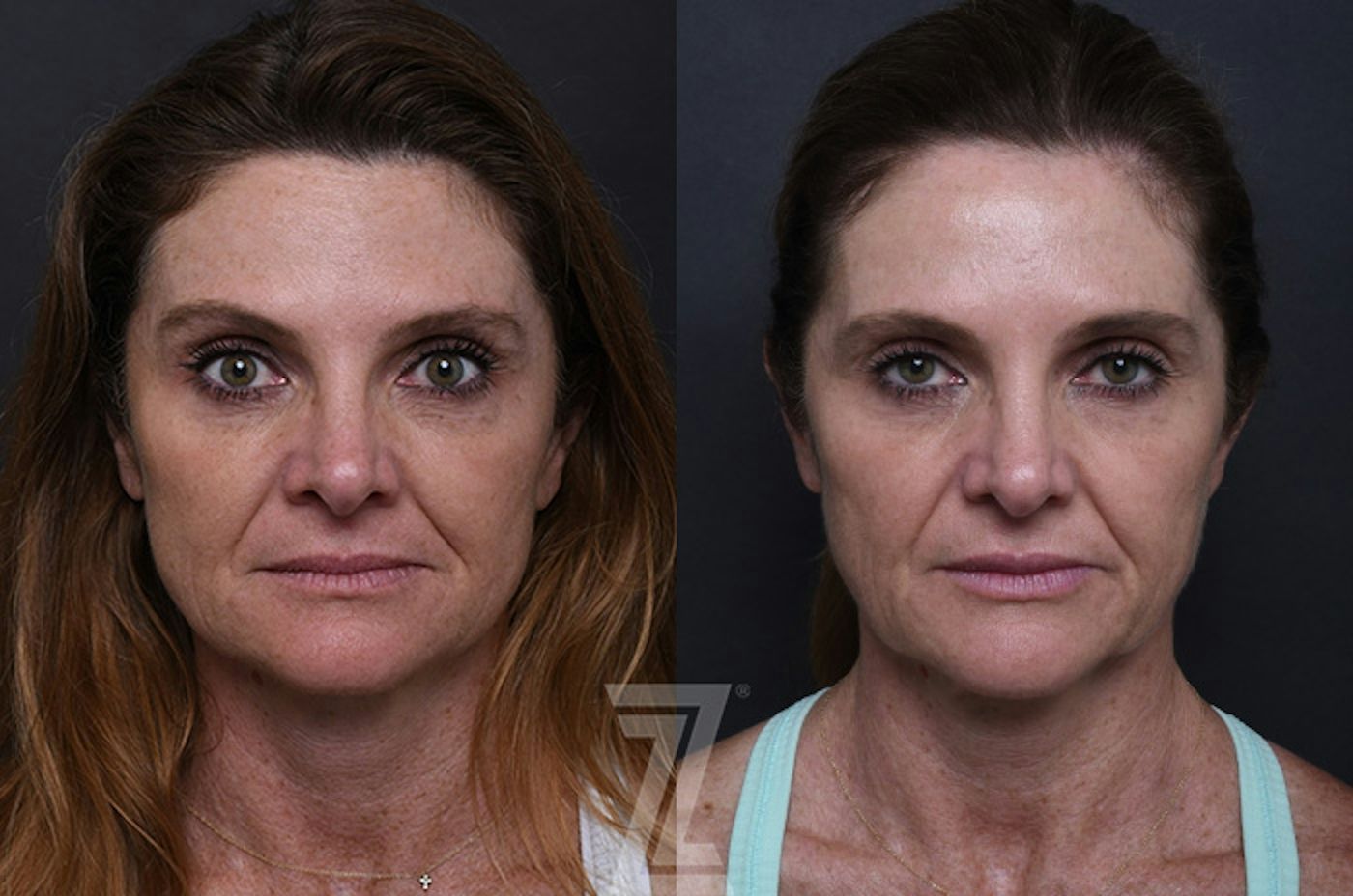 Austin ezGEL Before & After Gallery - Patient 129025 - Image 1 - The Piazza Center