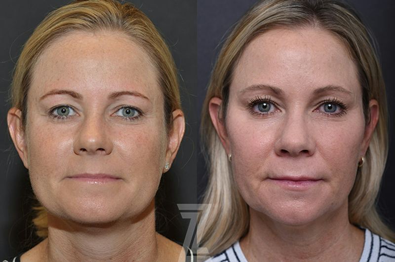 Austin Injectable Fillers Before & After Gallery - Patient 839826 - Image 1 - The Piazza Center