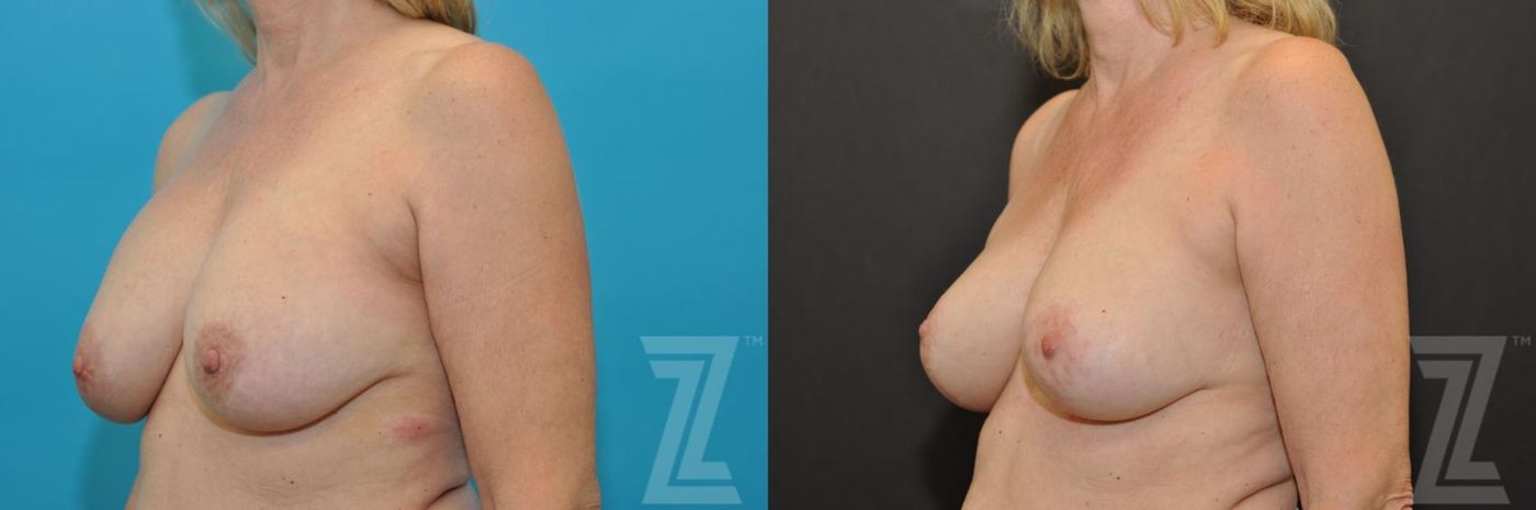 Austin Breast Augmentation Revision Before & After Gallery - Patient 132793346 - Image 2 - The Piazza Center