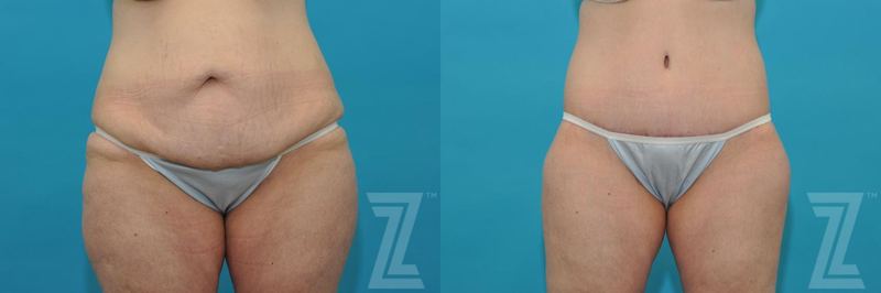 Austin Tummy Tuck Before & After Gallery - Patient 132886807 - Image 1 - The Piazza Center