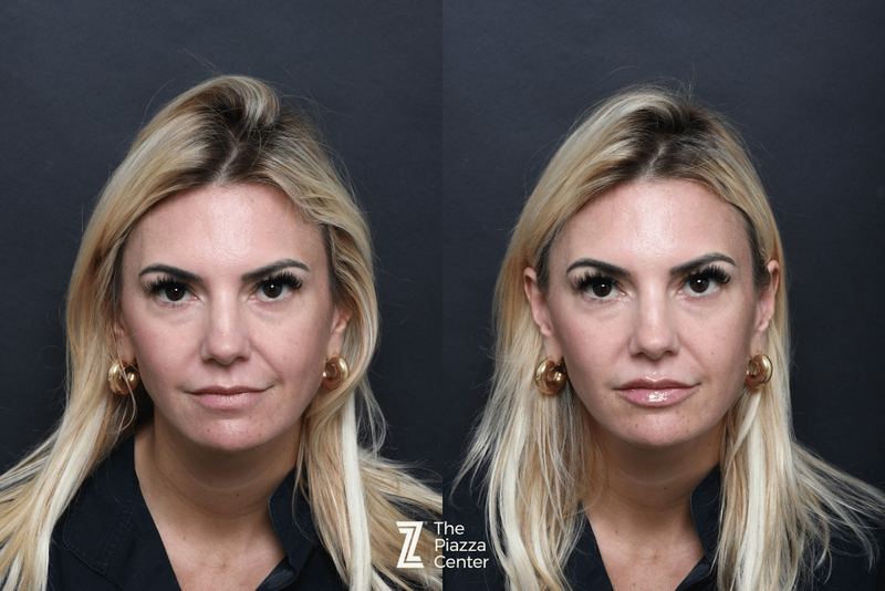 Austin Injectable Fillers Before & After Gallery - Patient 330475 - Image 1 - The Piazza Center