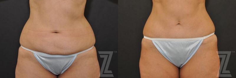 Austin Tummy Tuck Before & After Gallery - Patient 132886896 - Image 1 - The Piazza Center