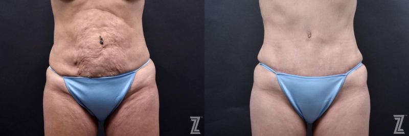 Austin Tummy Tuck Before & After Gallery - Patient 132886812 - Image 1 - The Piazza Center