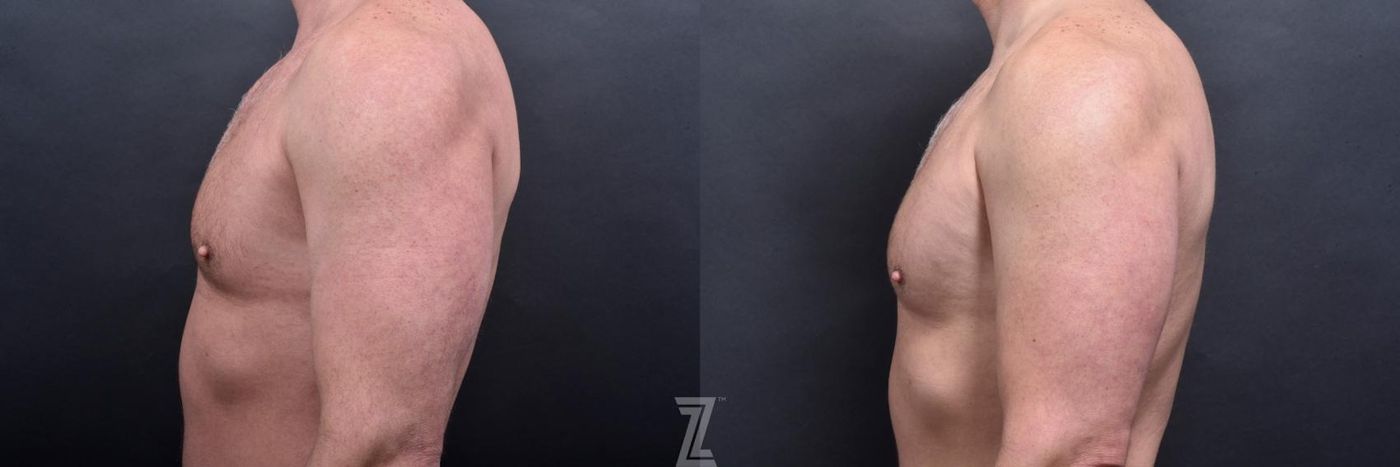 Austin Male Body Contouring Before & After Gallery - Patient 173307 - Image 5 - The Piazza Center