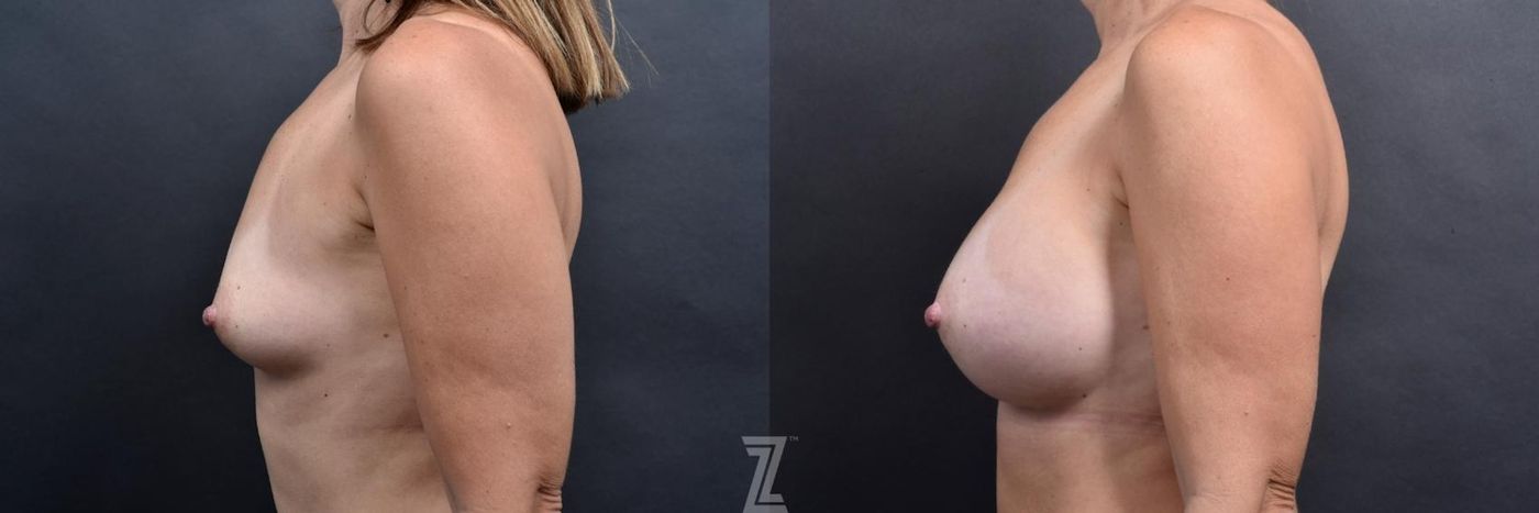 Austin side before and after images of 39 year old woman with Silicone Implants with Cohesive Silicone Gel - The Piazza Center - The Piazza Center