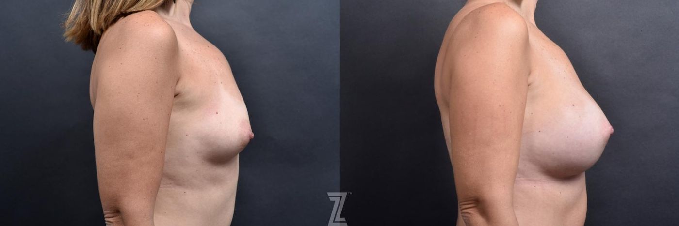 Austin lateral before and after images of 39 year old woman with Silicone Implants with Cohesive Silicone Gel - The Piazza Center - The Piazza Center